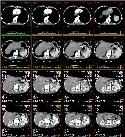 肺癌CT筛查模型